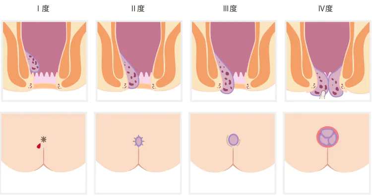 内痔核の分類